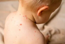 El Ministerio de Salud detectó un caso de sarampión en Entre Ríos y activó una alerta nacional